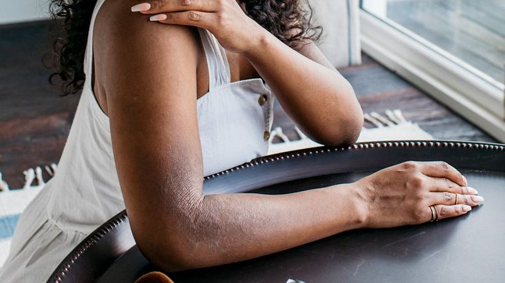 How Shea Butter Balms Help Eczema - Nature’s Answer to Soothing Skin