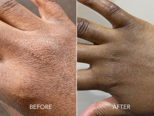 Eczema vs Dry Skin. What's the difference?