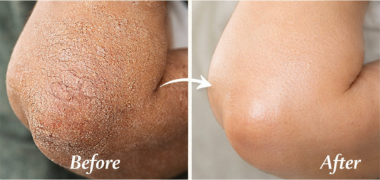 Best Natural Ingredients for Dry Skin